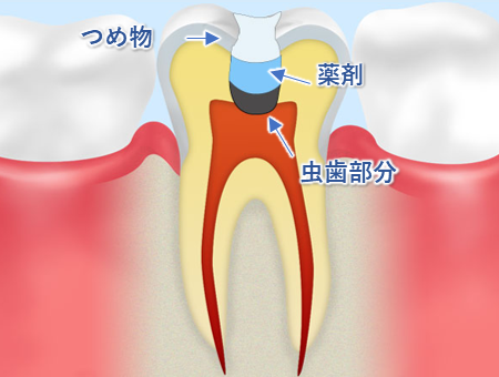 前橋市の歯医者、前橋けやき歯科・矯正歯科のなるべく神経を残す治療