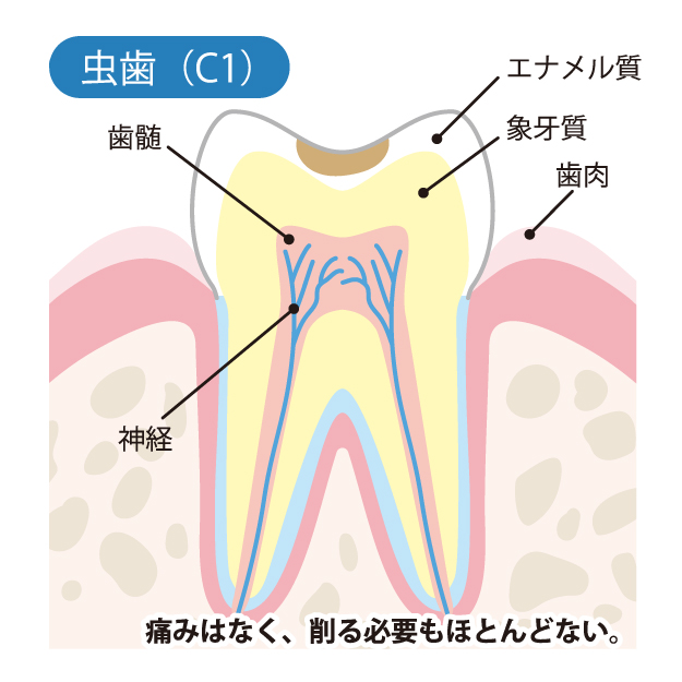 前橋市の歯医者、前橋けやき歯科・矯正歯科のなるべく削らず、痛くない治療
