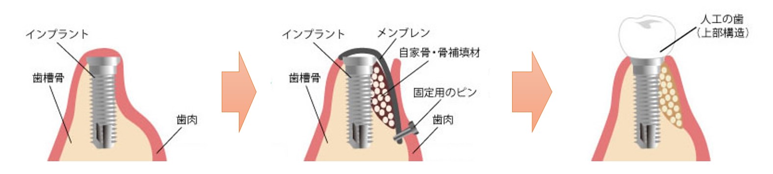 前橋市の歯医者、前橋けやき歯科・矯正歯科のインプラント治療