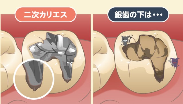 前橋市の歯医者、前橋けやき歯科・矯正歯科のなるべく削らず、痛くない治療