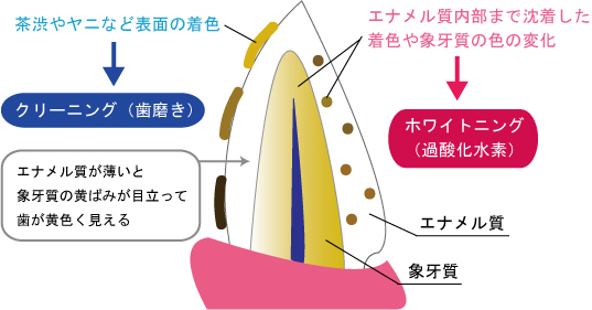 前橋市の歯医者、前橋けやき歯科・矯正歯科のホワイトニング